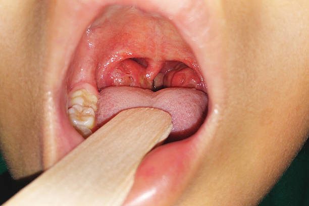 tonsillitis symptoms