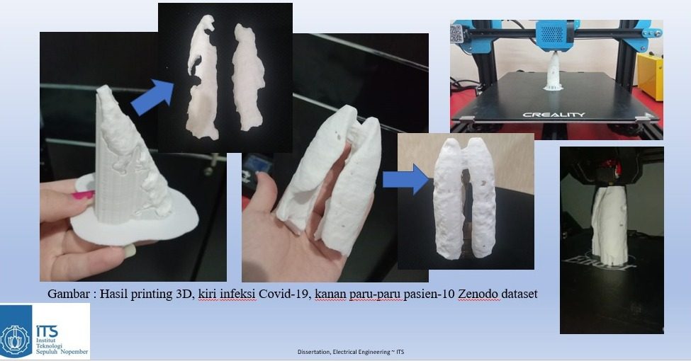 Gambar hasil printing 3D paru-paru dan luasan yang terinfeksi berdasarkan sistem intelijen